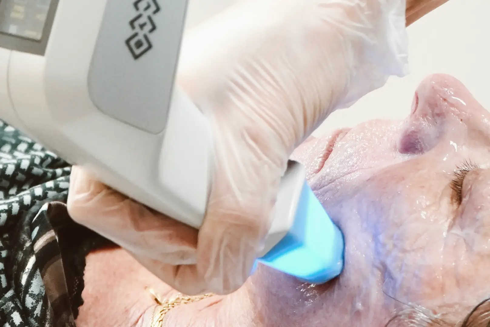 Athena Laser radiofréquence