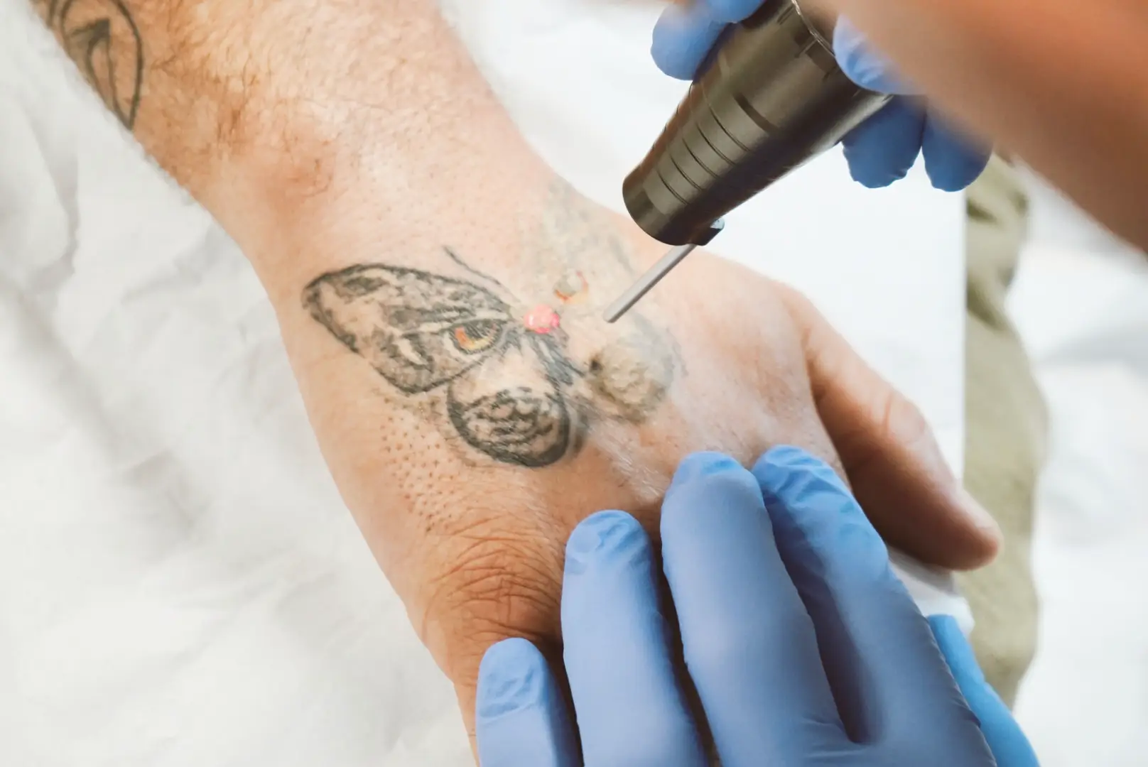 Athena Laser détatouage laser