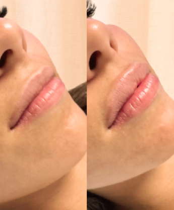 Soins esthétiques par injections chez Athena Laser