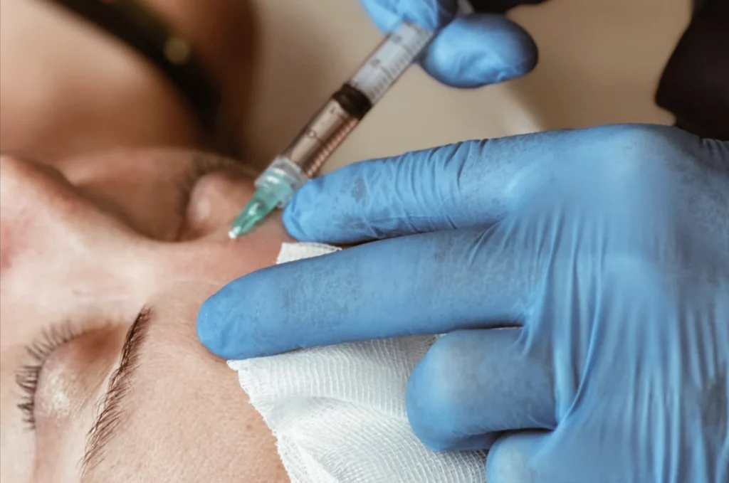 Athena Laser Injection d'acide hyaluronique