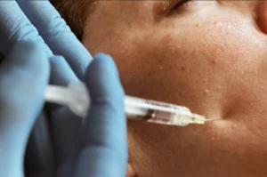Athena Laser mesotherapie
