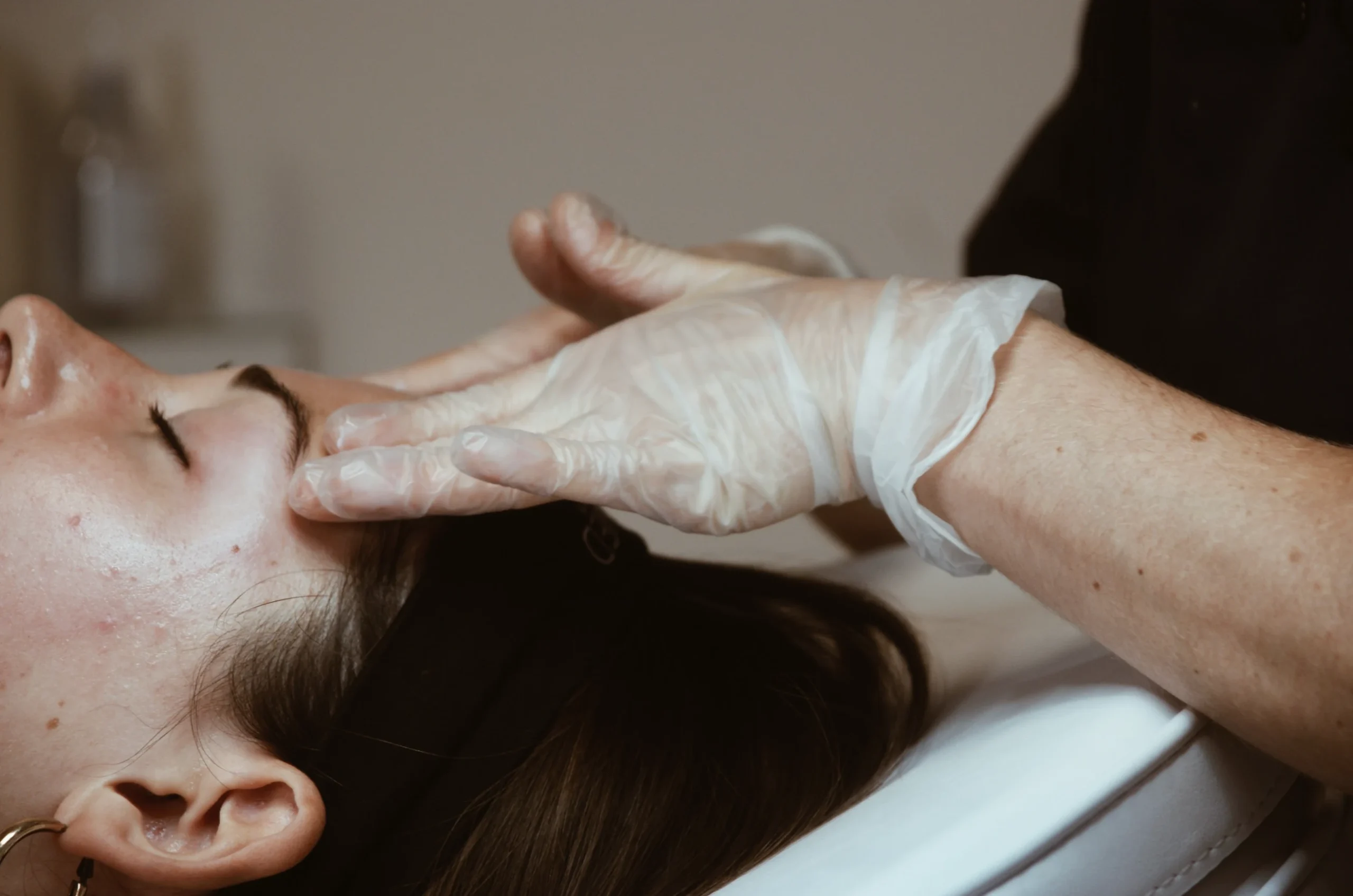 Athena Laser Peeling