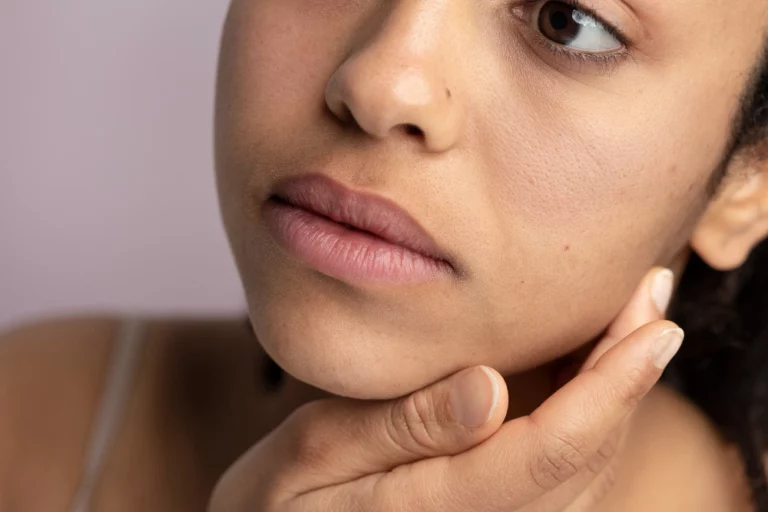 Athena Laser étirement de la peau