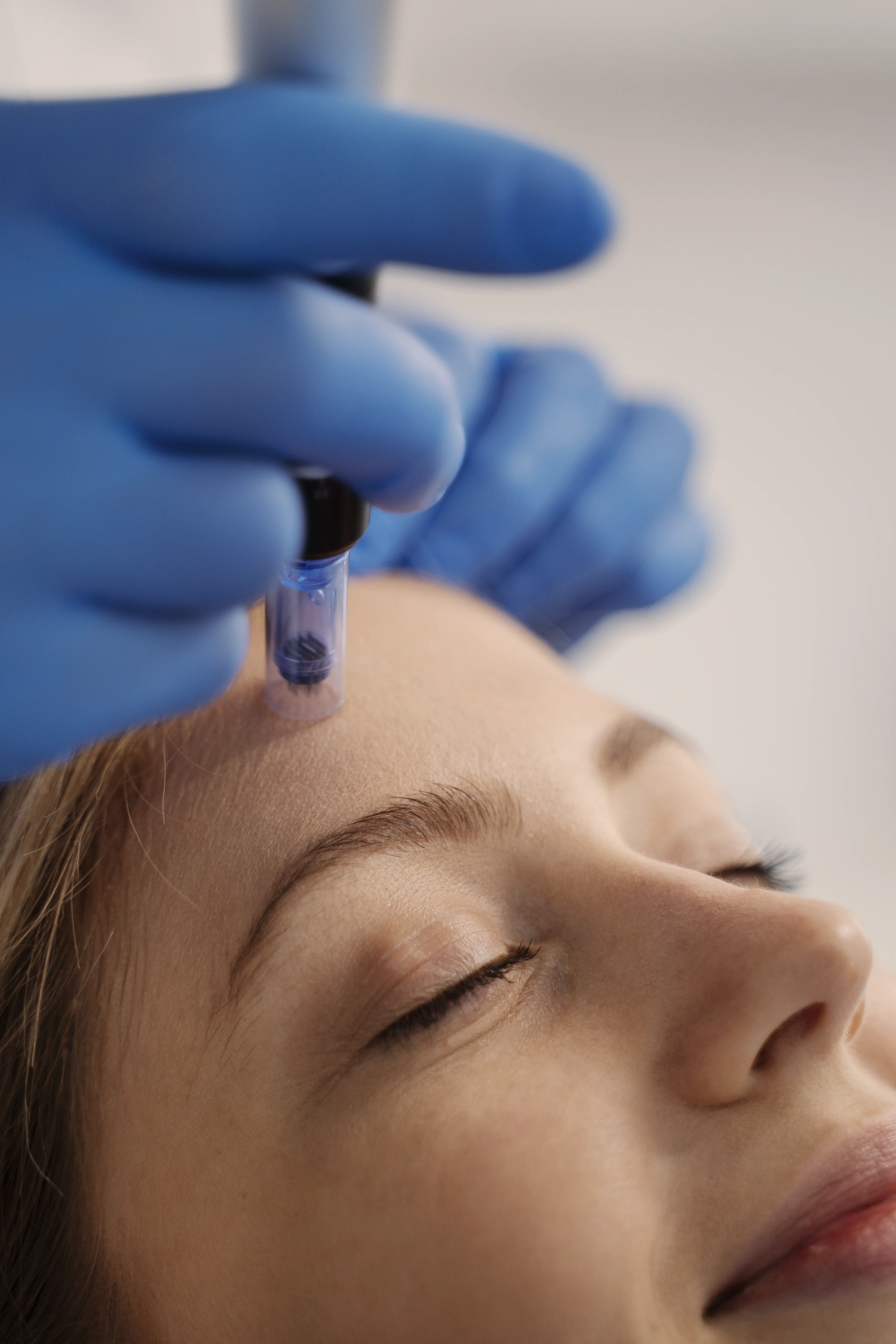 Athena Laser microneedling