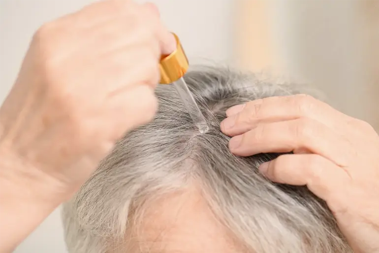 Athena Laser traitement chute de cheveux