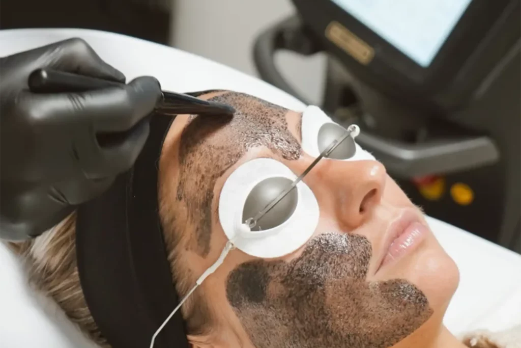 Athena Laser hollywood peel