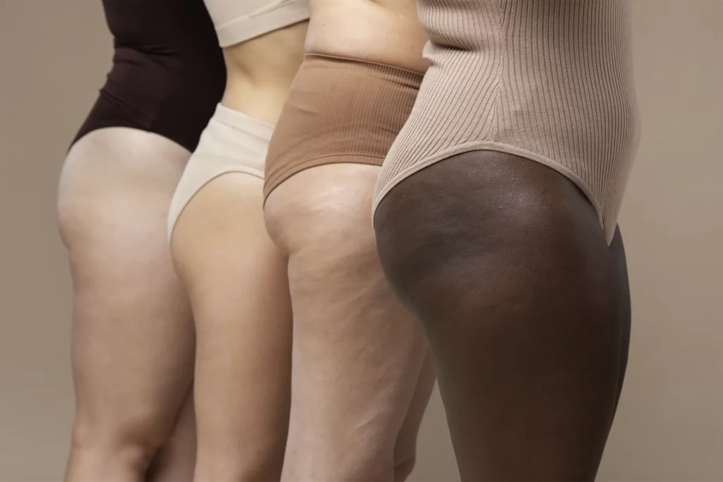 Athena Laser femmes avec cellullite