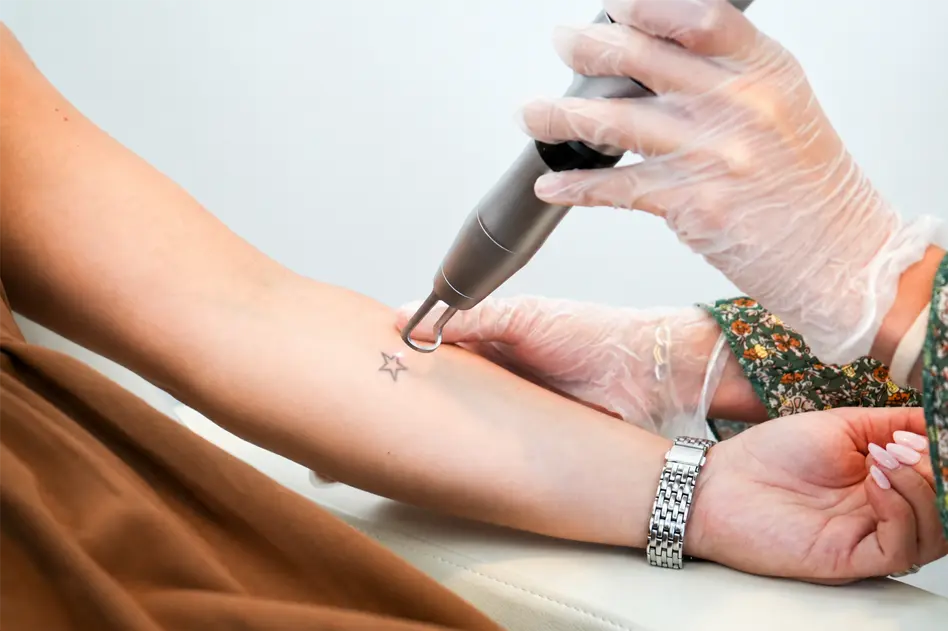 Athena Laser détatouage laser