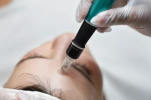 Athena Laser microneedling