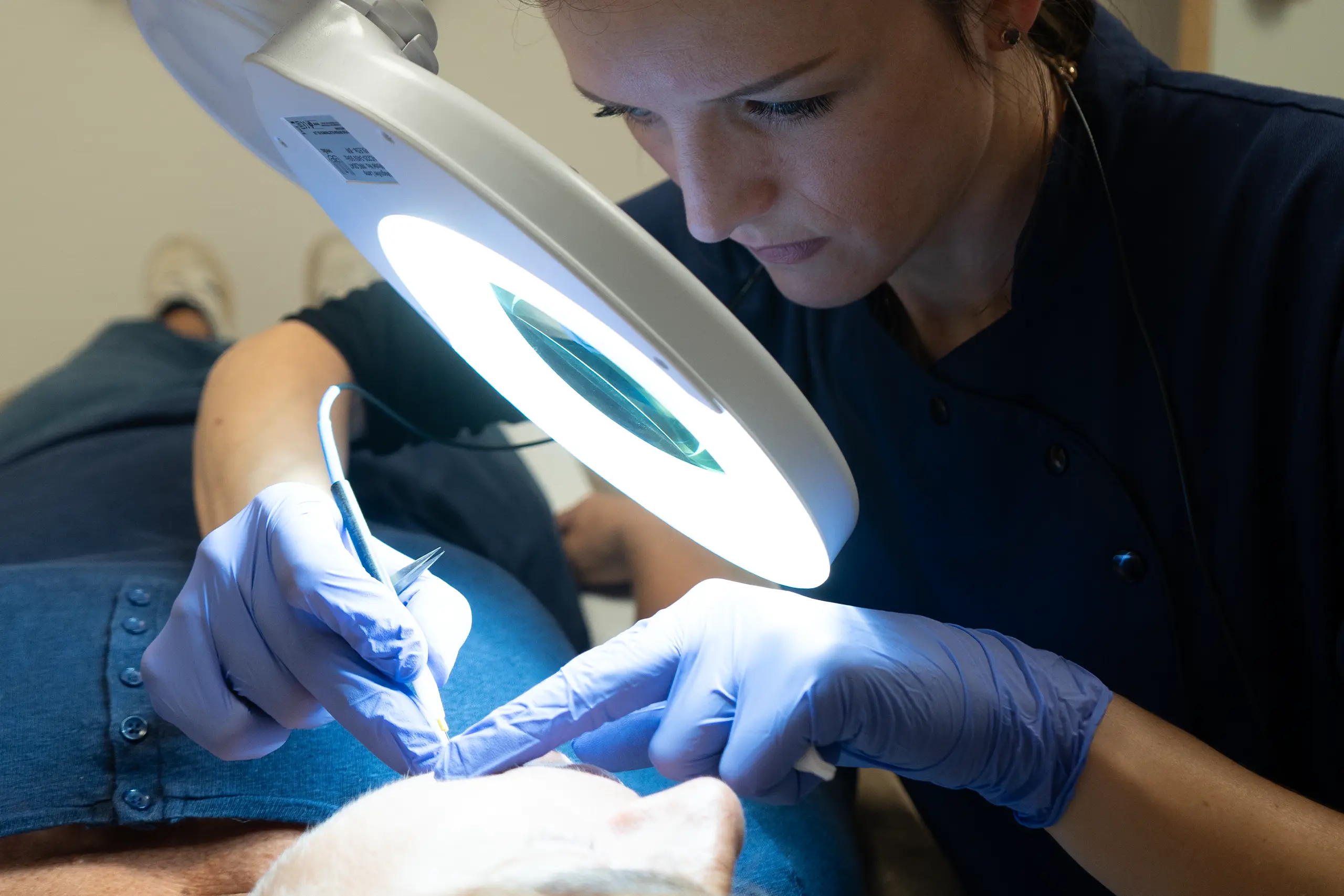 Athena Laser epilation par electrolyse