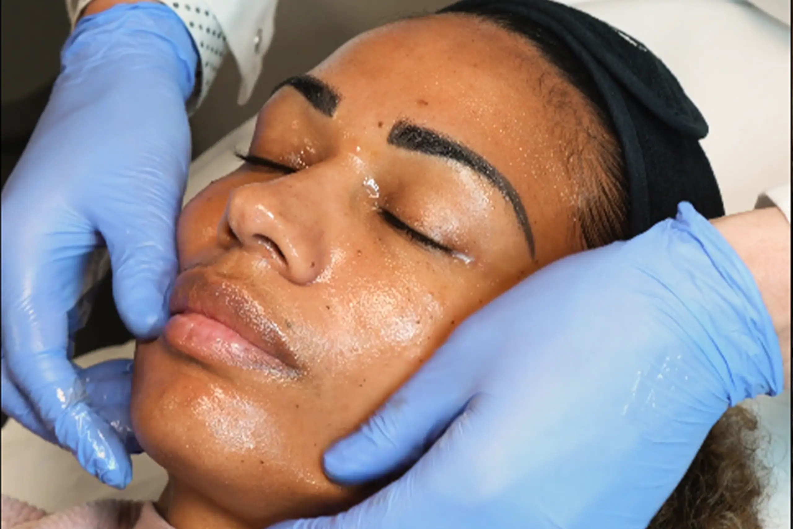 Athena Laser microneedling