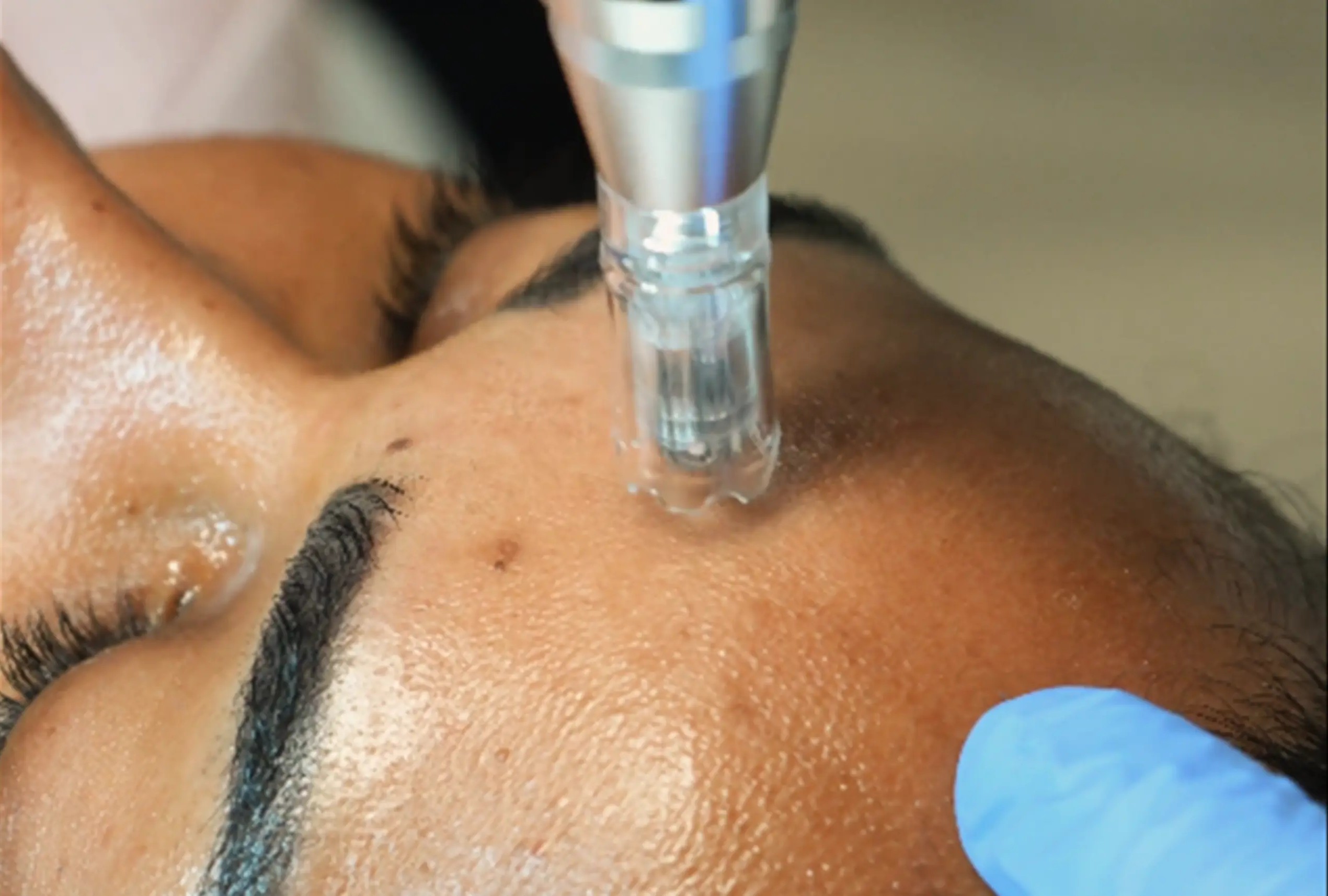 microneedling athena laser Le havre